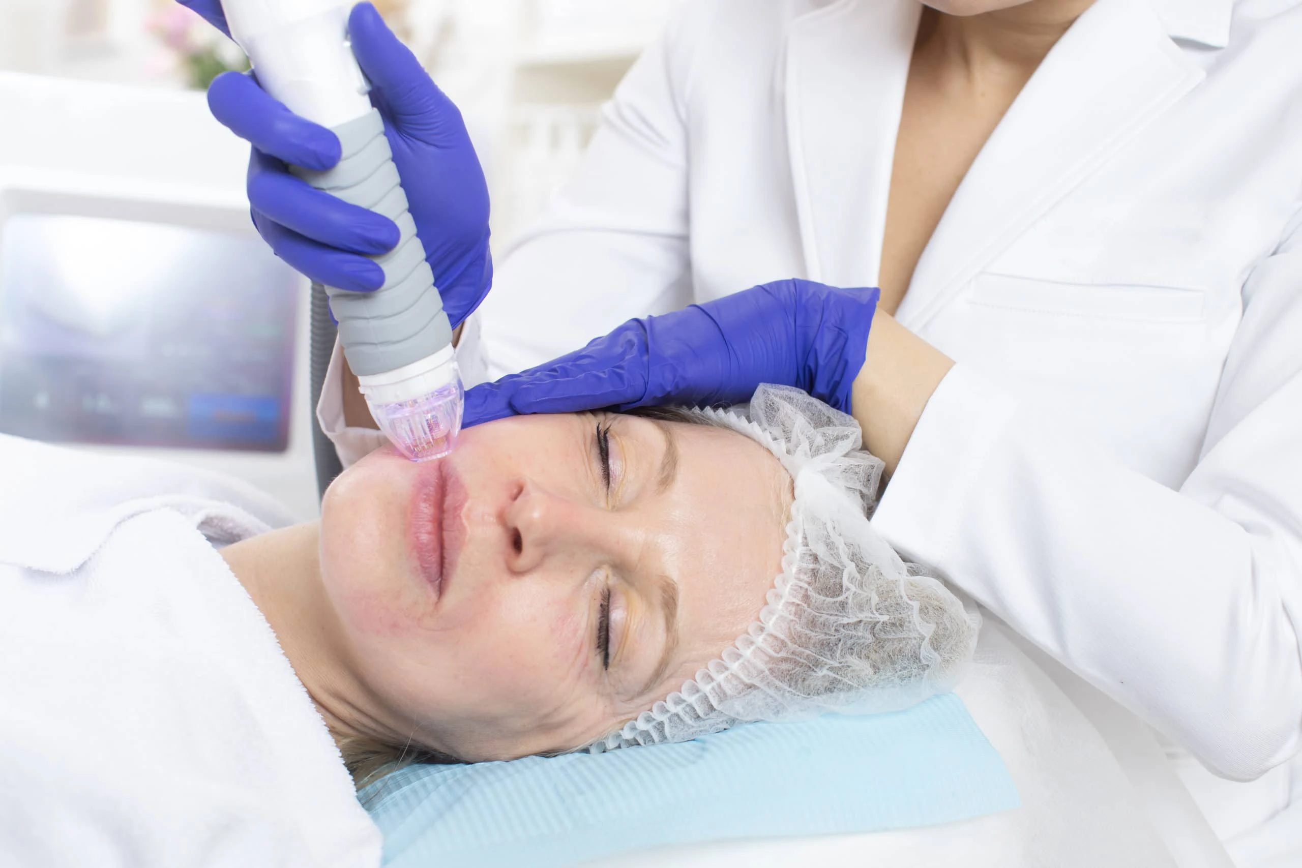 Huidspecialiste voert een microneedlingbehandeling uit op het gezicht