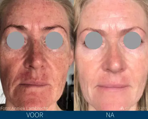 Voor-en-nafoto van een gezicht bij SkinPen