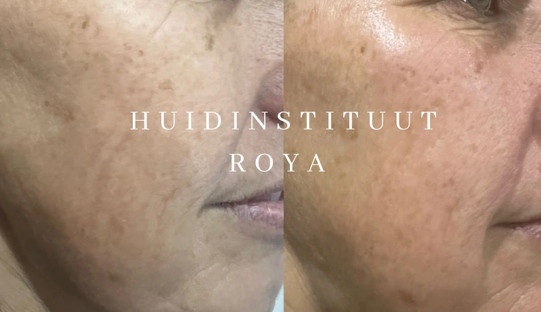 Voor-en-nafoto van huidstructuur op de buik bij RF-microneedling