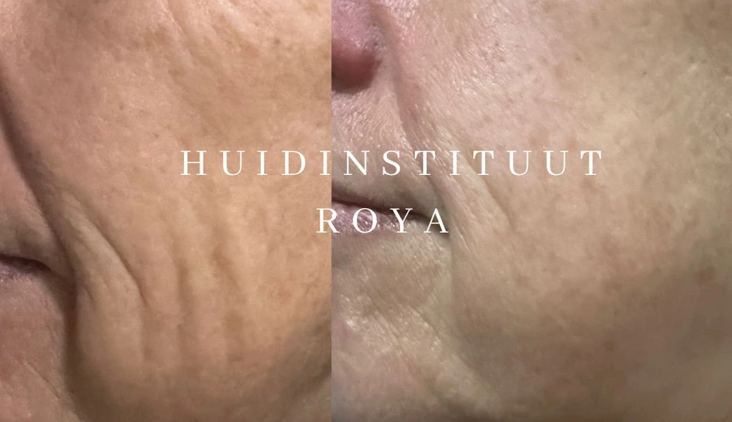 Voor-en-nafoto van huidstructuur op de buik bij RF-microneedling
