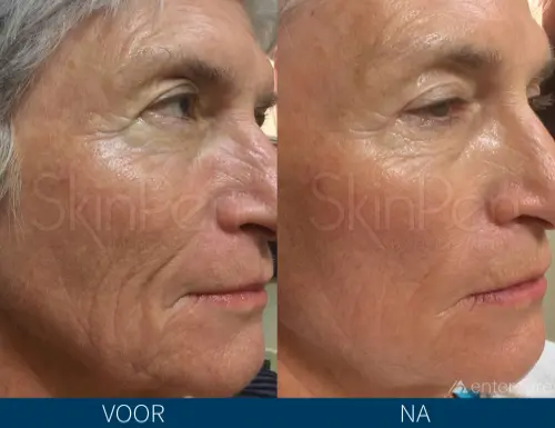 Voor-en-nafoto van huidstructuur op de wang bij SkinPen