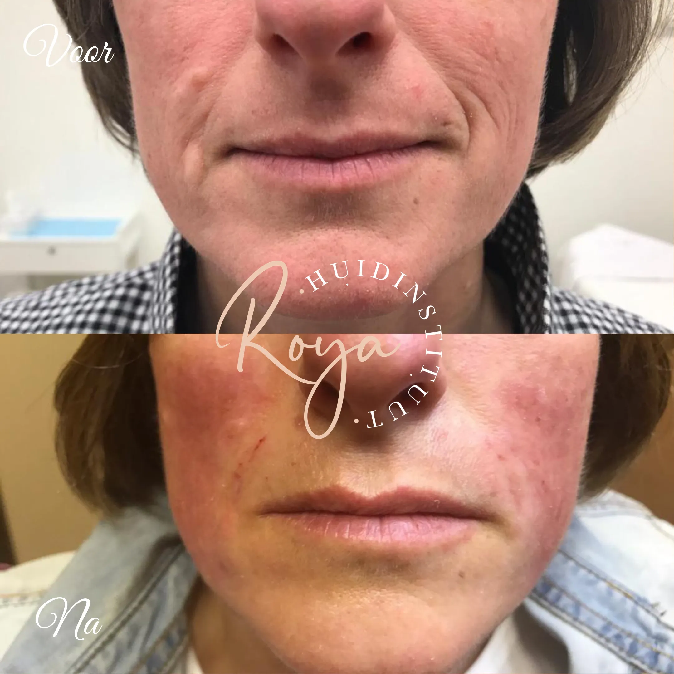 Voor-en-nafoto van lijntjes rond de mond bij mesotherapie