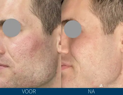Voor-en-nafoto van roodheid op de wangen bij SkinPen