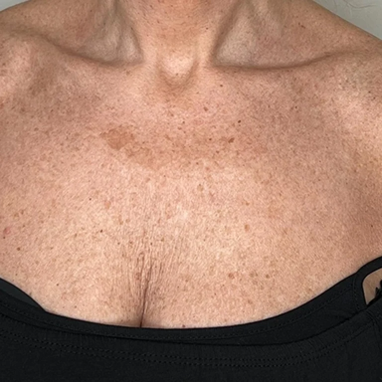 Hals & Decolleté Behandeling